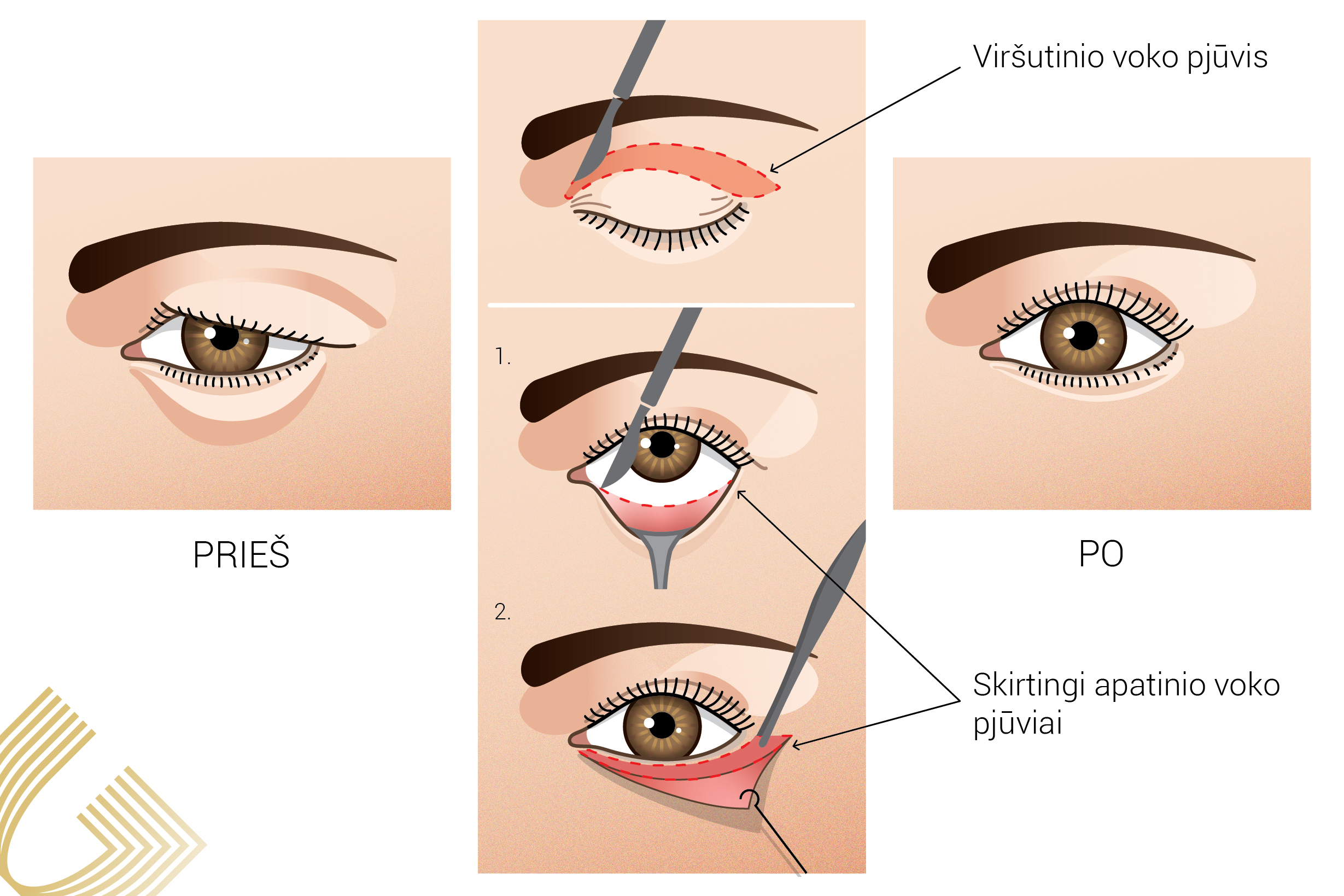 Akių vokų operacijos, Kaip natūraliai pašalinti vokų riebalus