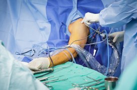 Peties operacija su balioniniu OrthoSpace implantu